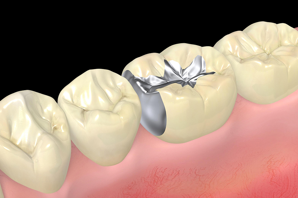 保険インレー ※保険