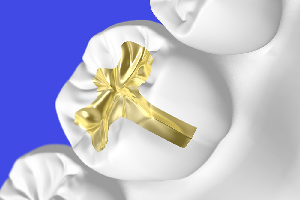 ゴールドインレー ※自費