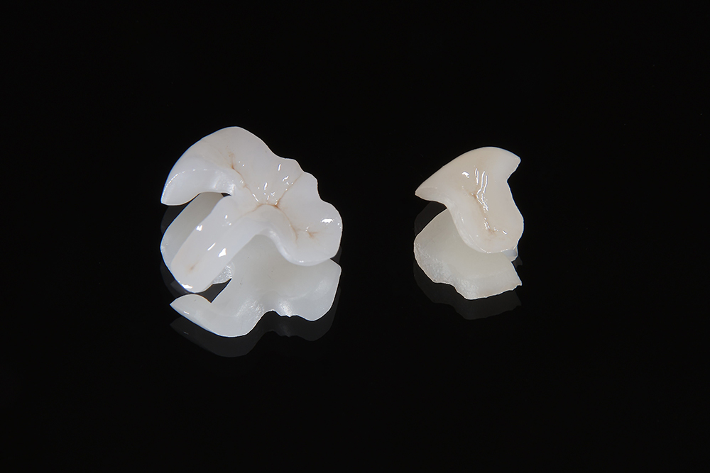 オールセラミックスインレー ※自費