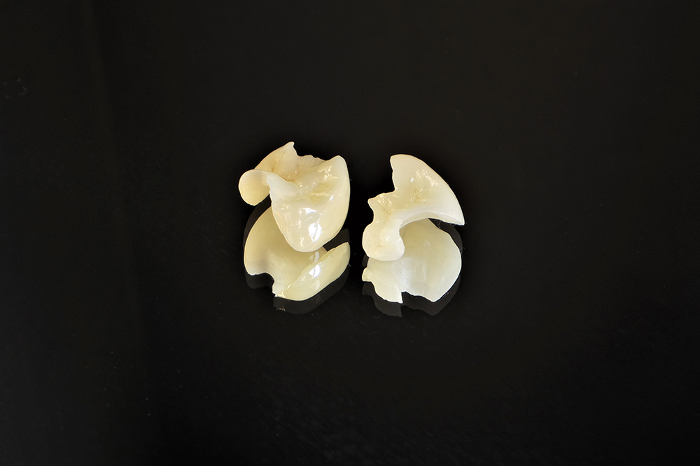 ジルコニアインレー ※自費