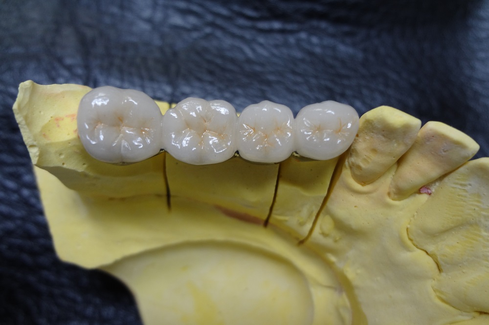 メタルボンド（イージーオーダー）